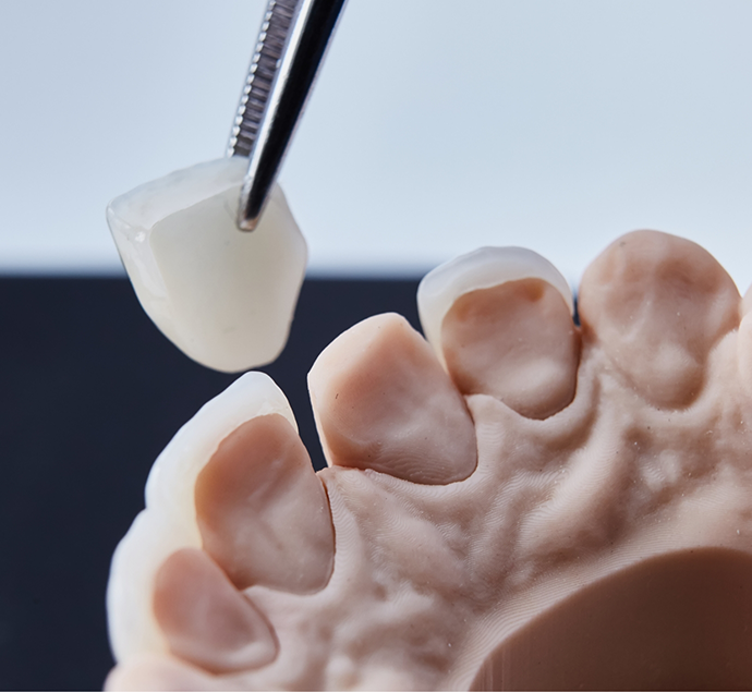 Cosmetic dentist holding a veneer with tweezers and placing it over a model of a tooth