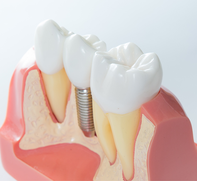 Model of a dental implant in between two natural teeth