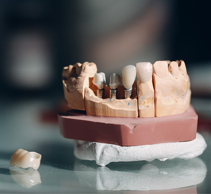 Model of the lower jaw with three dental implants in Austin replacing three missing teeth