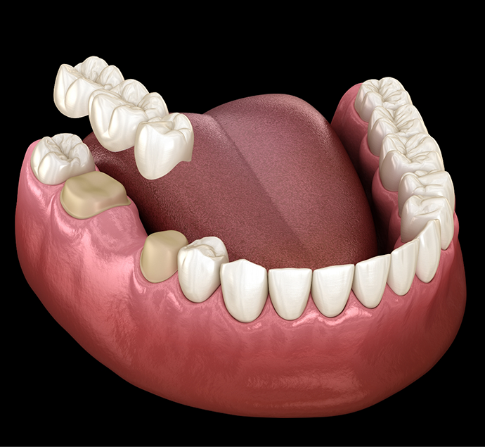 Illustration of a dental bridge being placed over two teeth to replace the missing tooth between them
