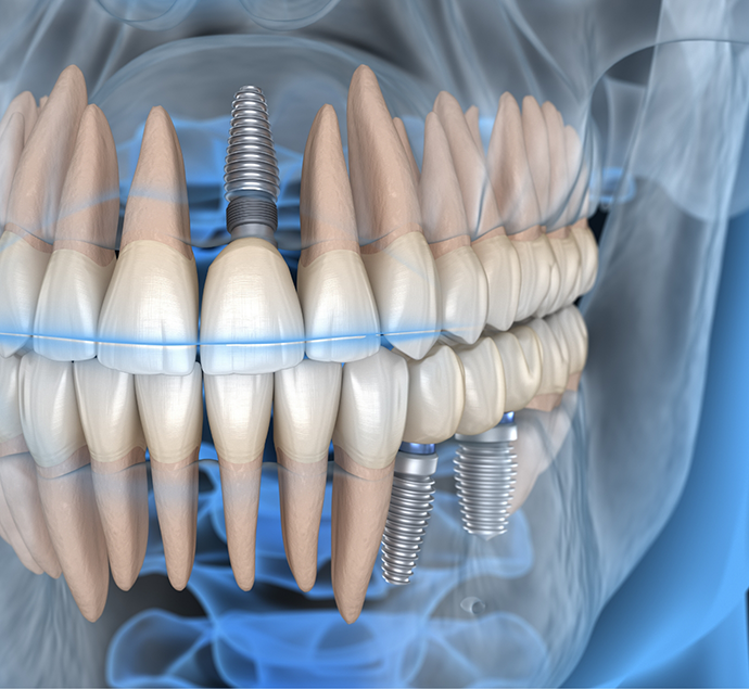 Illustration of an x ray of a person with dental implants replacing several missing teeth