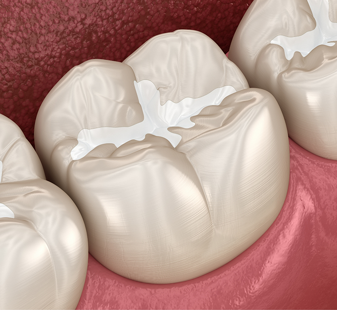 Illustration of a tooth with a white filling