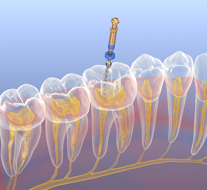 Illustration of a thin dental instrument treating the center of a tooth during root canal treatment