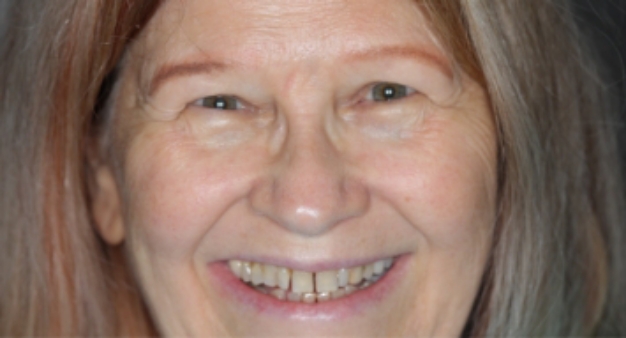 Woman smiling with yellowed and gapped teeth