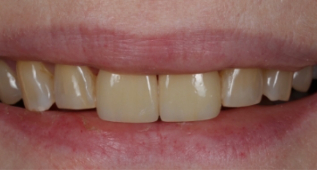 Close up of a smile after treating tooth stains