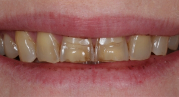 Close up of a smile with stained teeth