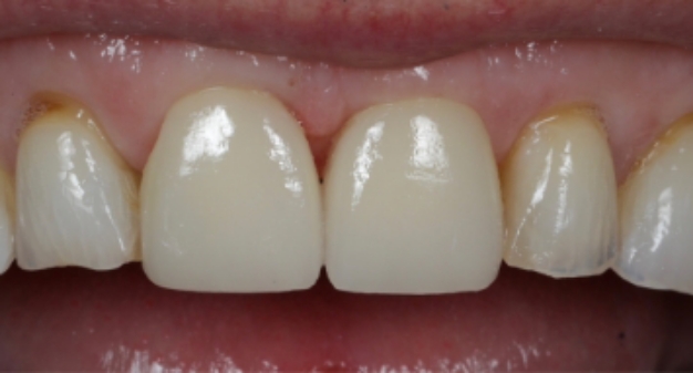 Close up of a smile with a newly restored front tooth
