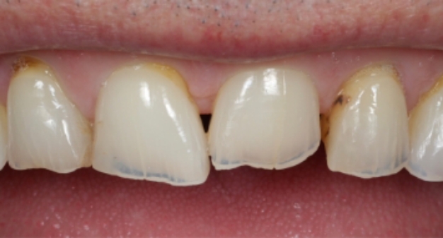 Close up of a smile with a chipped front tooth