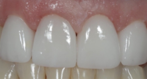 Close up of a row of whiter upper teeth