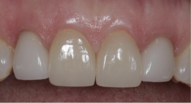 Close up of a row of slightly discolored upper teeth