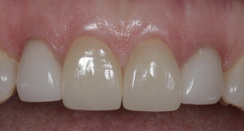 Close up of a row of slightly discolored upper teeth