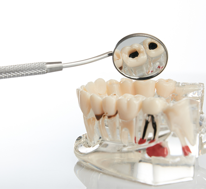 Dental mirror reflecting a model of a mouth with several decayed teeth needing tooth extractions in Austin