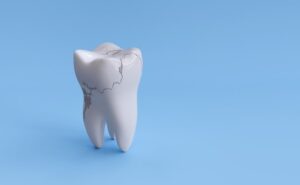 3D model of a cracked tooth